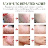 Herbal Acne Removal Face Cream - Shoply